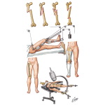 Fracture of Shaft of Femur