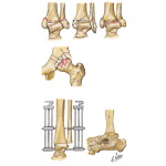 Posttraumatic Osteoarthritis