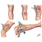 Classification of Open Fractures
