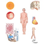 Diabetes Mellitus and Its Complications: Micro and Macrovascular Complications