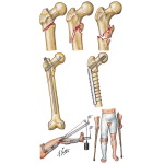 Subtrochanteric Fracture of Femur