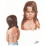 Fracture in Abused Children