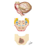Occlusion of Basilar Artery and Branches