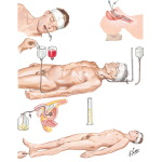 Initial Management of Severe Head Injuries