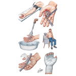 Infected Wounds of Hand and Fingers