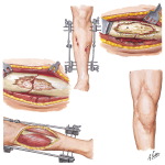 Osteomyelitis After Open Fracture