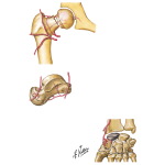 Osteonecrosis After Fracture