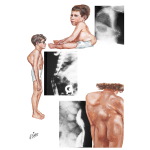 Congenital Kyphosis
