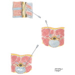 Injection Techniques