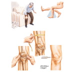 Clinical Findings In Osteoarthritis (OA)