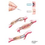 Percutaneous Coronary Intervention, Atherectomy Procedures
