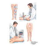 Noninvasive Tests for Occlusive Peripheral Arterial Disease (PAD)