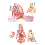 Organ-Specific Complications