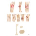 Classification of Fracture; Open and Closed Fractures