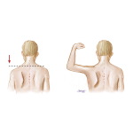 Clinical Findings In Cranial Nerve XI Damage
