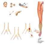 Peripheral Vascular Disease