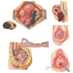 Endometriosis