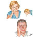 Migraine Headaches