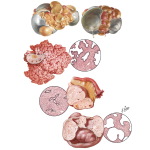 Epithelial Stromal Ovarian Tumors