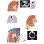 Lung Cancer (Stage IIIA and IIIB)