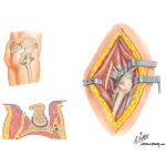 Surgical Approaches of the Thigh and Hip