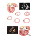 Left Ventricular Hypertrophy