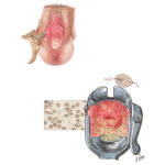Sexually Transmitted Infections: Trichomanas Vaginalis