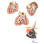 Mitral Stenosis