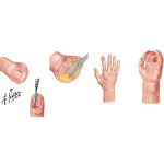 Disorders: Infections