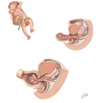 Umbilical Hernia