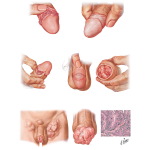 Warts, Precancerous Lesions, and Cancer