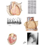 Pericarditis