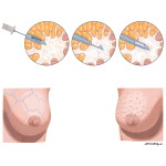Breast: Cancer
