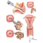 Postmenopausal Vaginal Bleeding