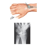 Ganglion of Wrist