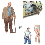 History of Trauma to the Thigh and Hip