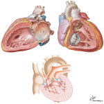 Ventricular Septal Defects