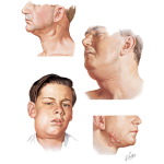 Neck Masses In Adults