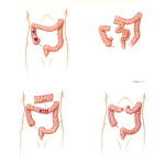 Abdominal Wounds of Colon