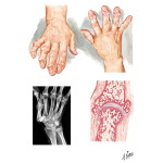 Hand Involvement In Osteoarthritis