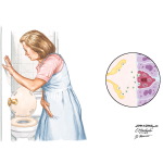 Irritable Bowel Syndrome