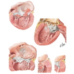 Bacterial Endocarditis in Mitral Valvular Disease