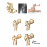 Thigh and Hip Trauma