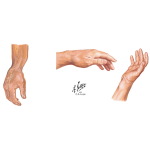 Fracture of Scaphoid