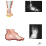 Disorders of the Foot and Ankle