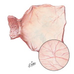 Gastritis