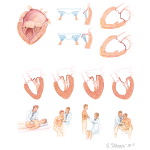 Ausculation In Mitral Valve Prolapse