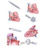 Interventional Approaches to Peripheral Arterial Disease