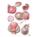 Hydrosalpinx (Chronic Pelvic Inflammatory Disease)