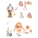 Cardiovascular Disease in Diabetes